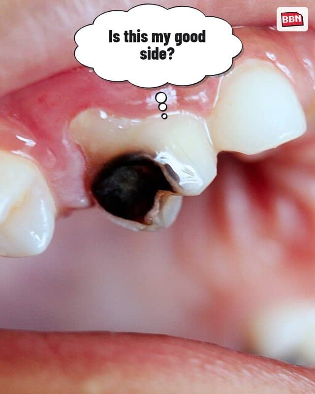 Photo: Tooth decay